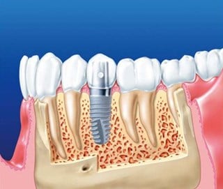 implantat-schema.jpg