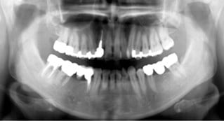 röntgen tänder.jpg