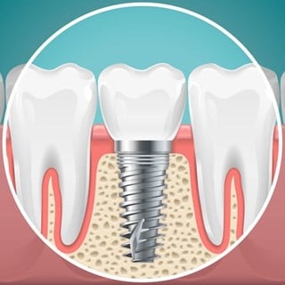 implantat___serialized1.jpg